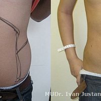 kombinovaná tumescentní liposukce břicha a boků u mladého muže
